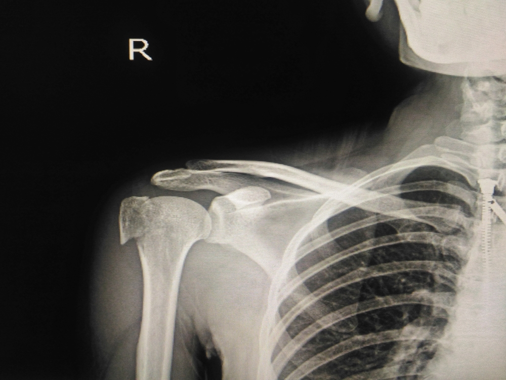 Artroplastia de hombro