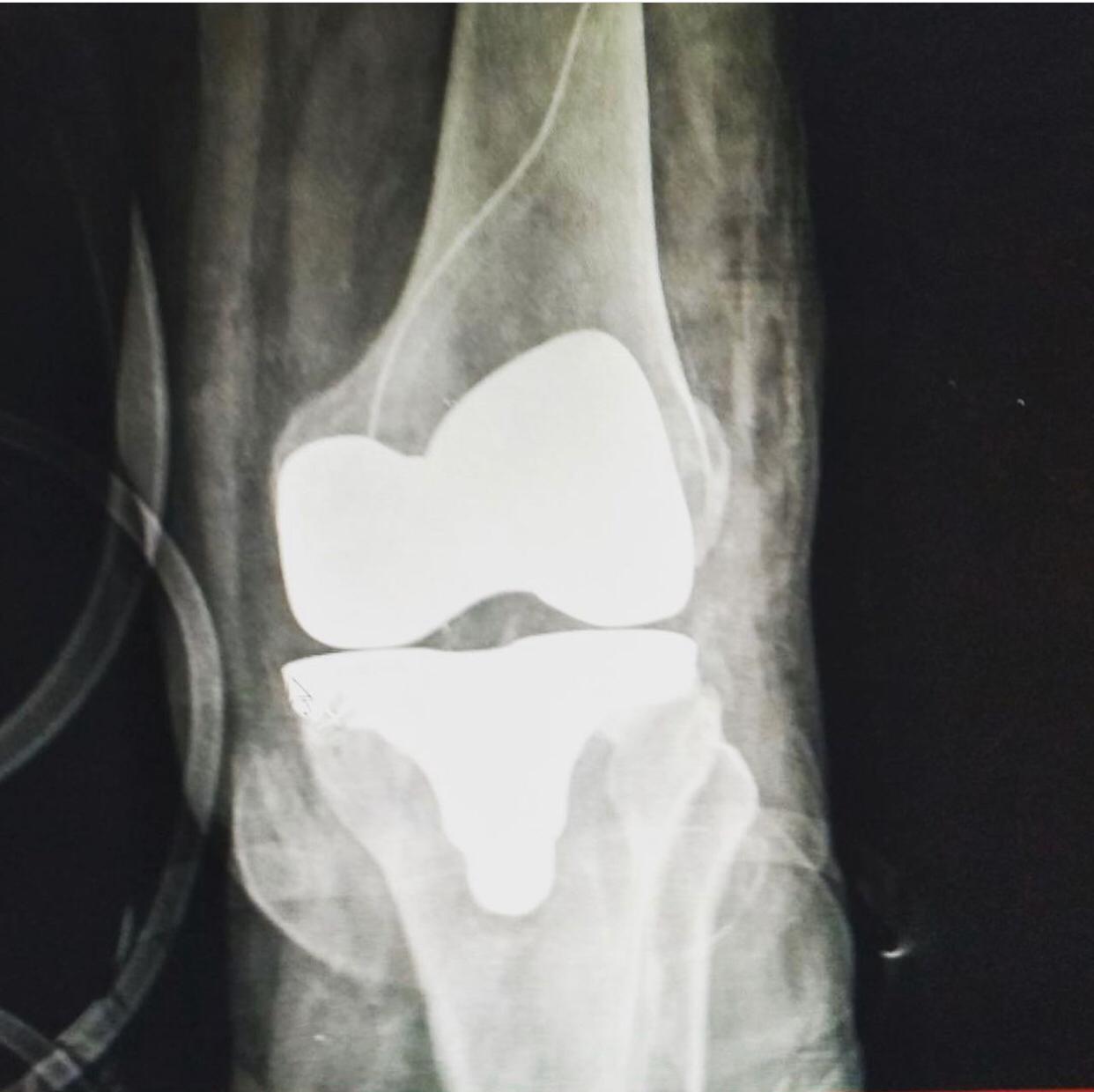 Artroplastia de rodilla